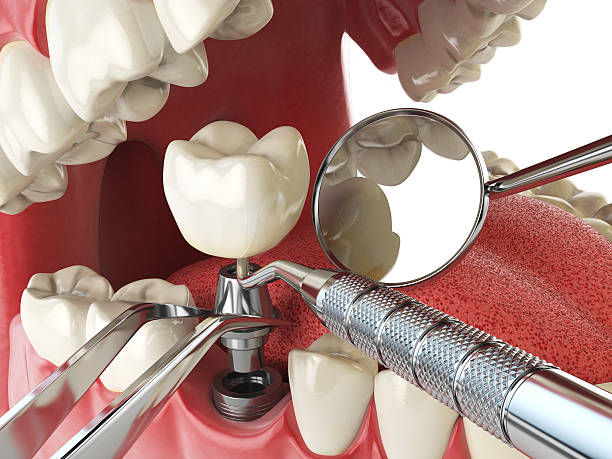 Best Emergency Tooth Extraction in Cowpens, SC